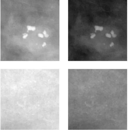 Figure 7. Raw image patches (left) and normalized image patches (right)  In addition to mass and microcalcification, two classes of normal tissue and  background were added to allow the network to learn more specific localization