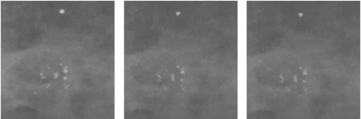 Figure 8. The raw microcalcification image patch (left), image with 2-magnitude elastic  distortion(middle), image with 4-magnitude elastic distortion(right) 