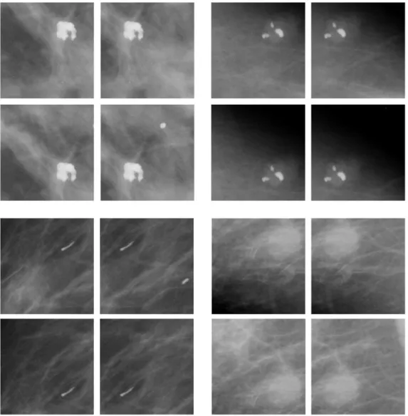 Figure 10. Illustration of image tranclastion with cropping; augmented microcalcification  image patches 