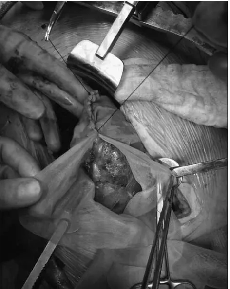 Fig. 3. MP-02.04. Process of salvaging damaged renal allografts.