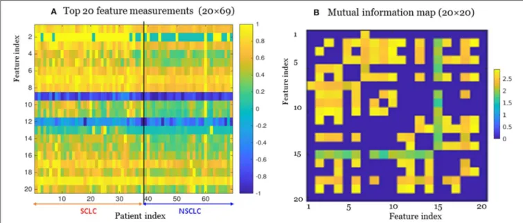 FIGURE 3 | The top 20 features selected from the radiomic data set (total 1,731 features) for the small cell lung cancer (SCLC) / non-small-cell lung cancer (NSCLC) classification