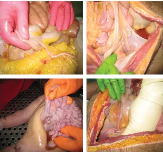 Figure 1. Histogram showing the incidence of anatomical positions of the appendix in Iranian cadavers (n = 693).