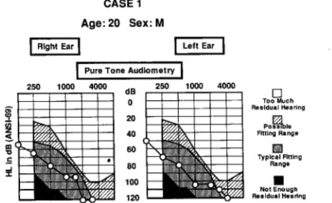 Figure lb shows an aided narrow-band- narrow-band-noise audiogram comparing the conventional  hearing aid fitting with the TranSonic fitting