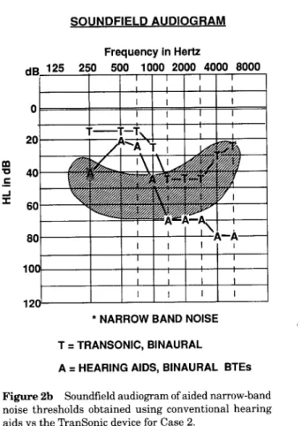 Figure 1d  Comparison between conventional hearing  aids and Transonic device on four Subscales of the APHAB  questionnaire for Case 1