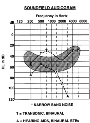 Figure 4b shows an aided narrow-band- narrow-band-noise audiogram comparing the conventional  hearing aid fitting with the Transonic fitting