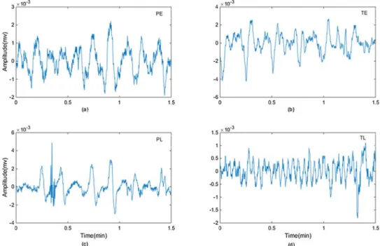 Fig. 3  – Examples of EHG segments (1.5 min) from: (a) PE (recorded before the 26 th  week of gestation, with preterm delivery); (b)  TE (recorded before the 26 th  week of gestation, with term delivery); (c) PL (recorded during or after the 26 th  week of