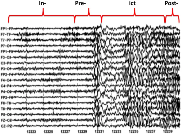 Figure 5.1 Illustration of the four classes of interest where ictal indicates the epileptic seizure