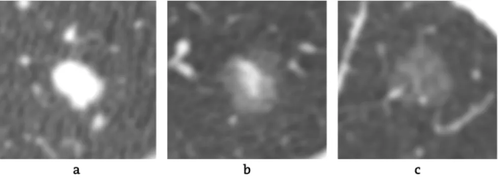 Figure 1   CT images of the three subtypes of pulmonary nodules:  
