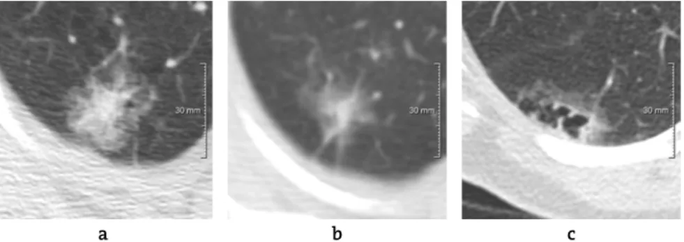 Figure 2.1   CT scans show malignant SSNs correctly upgraded by all six observers.