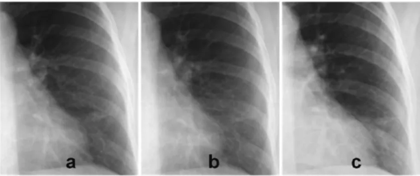 Figure 1   Images of the left lower lung demonstrate the potential of dose reduction of DR as  compared to (powder) CR: image b (DR) was obtained with 50% of the dose compared to a  (DR) and c (CR)