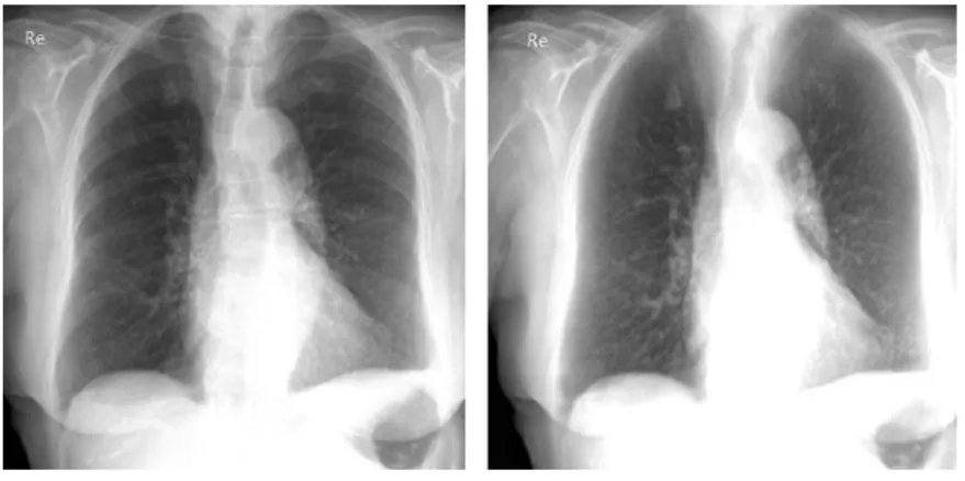 Figure 4   Example case 3. 83 year old female without a nodule. Incomplete suppression of   the first rib produces a pseudolesion in the right upper quadrant in the BSI, which was called  positive by two observers.