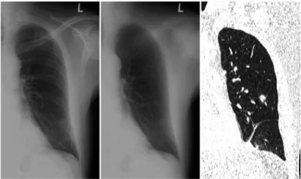Figure 2   Upright radiograph with a very subtle lesion in the left lower lobe. Without BSI only  one observer marked the small lesion
