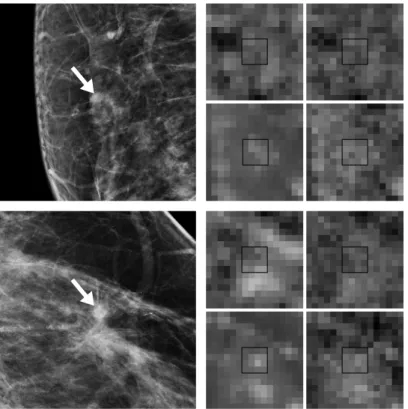 Figure 2.8. Examples of masses that were still missed despite the methods proposed in this study (left) and crops of the original unprocessed feature images associated with them (right)
