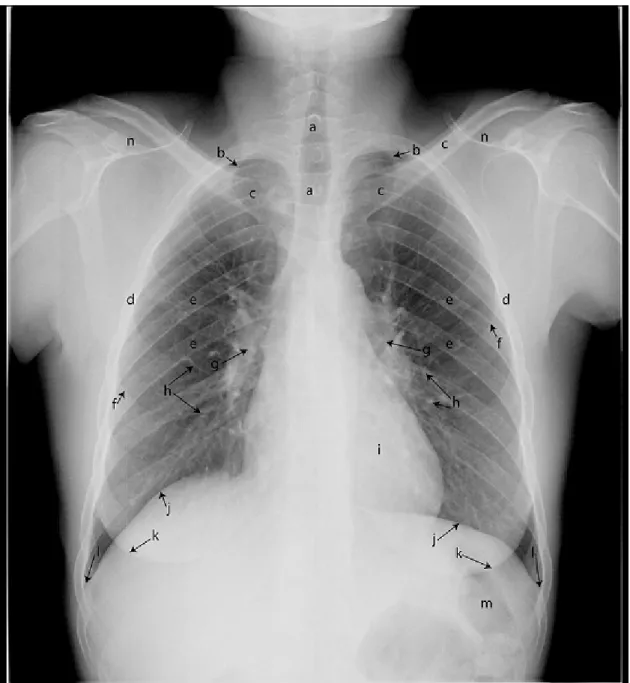 Figure 1.5: Important anatomical structures labeled in a normal PA chest radio- radio-graph