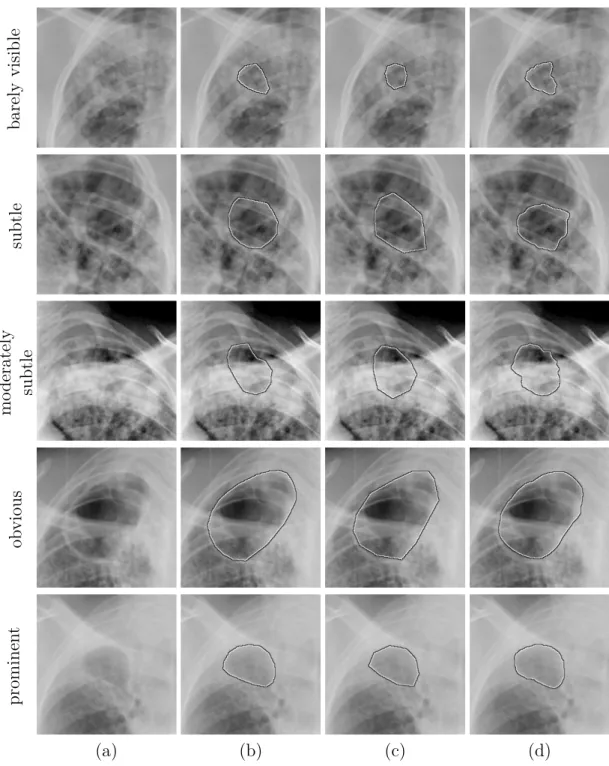 Figure 3.9: Cavity segmentation results for various subtlety categories. (a) Cavity image (b) Reference segmentation (c) Segmentation by the independent observer (d) Automatic segmentation using RF -F all classifier.