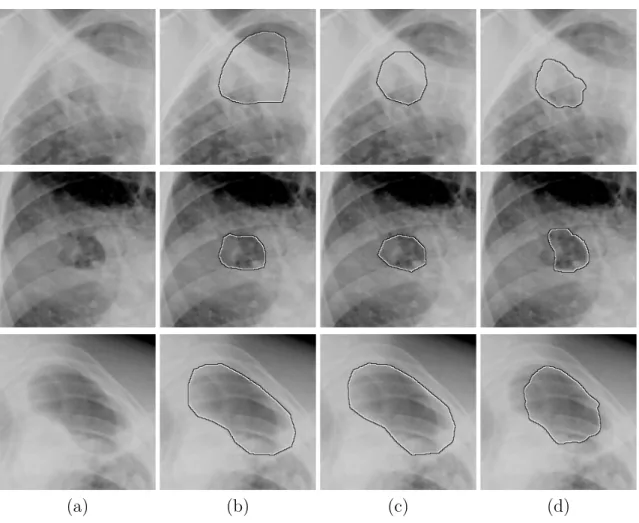 Figure 3.12: Examples of inaccurate segmentations calculated by the proposed automatic cavity segmentation method: (a) Cavity image, (b) Reference  segmenta-tion, (c) Segmentation by the independent observer, (d) Automatic segmentation using RF -F all clas