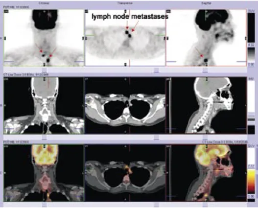 Figure 4. This FDG-PET/CT of the same patient demonstrated paratracheal pathologic uptake,  according to lymphnode metastases, which were confirmed after reoperation.