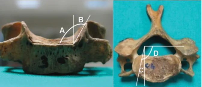 Figure 3. Inclination angle of uncinate process relative to sagittal plane (B), angle between medial surface of uncinate process and superior surface of vertebra (A+B), angle between long axis of uncinate process and sagittal plane (C), angle between long 