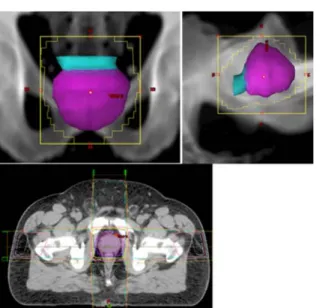 Figure 11b. Contemporary digitally reconstructed radiographs (DRR) from  planning CT, with prostate a seminal vesicles reconstructed from contouring on  successive CT slices and single CT slice dose distribution demonstrating coverage  of prostate, &amp; a