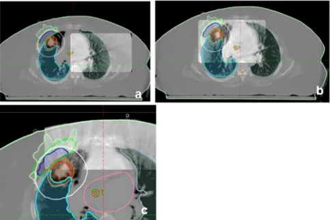 Figure 7. Cone beam CT of prostate showing location of prostate. Daily cone- cone-beam images enable the same adjustment of patient as fiducial markers to place  dose distribution accurately as prostate shifts