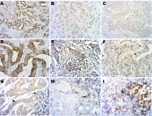 Figure 1: Immunohistochemical staining of PD-L1 in gastric adenocarcinoma tissues.  (A) Strong expression of PD- PD-L1 on tumour cells
