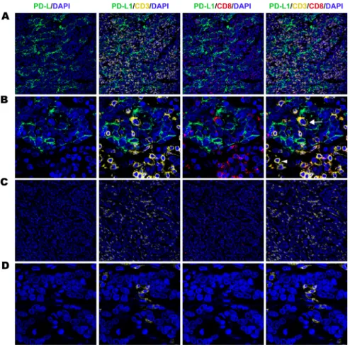 Figure 2: Fluorescent multiplex immunohistochemistry (mIHC) staining pattern for tumour cell PD-L1 and TILs  in gastric adenocarcinoma tissues