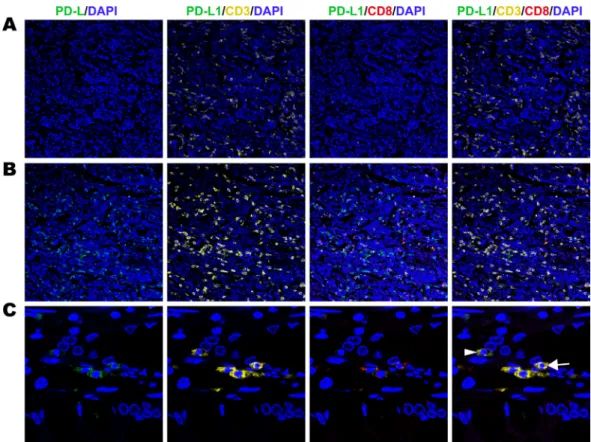 Figure 3: Fluorescent multiplex immunohistochemistry (mIHC) staining pattern for immune cell PD-L1 and TILs  in gastric adenocarcinoma tissues