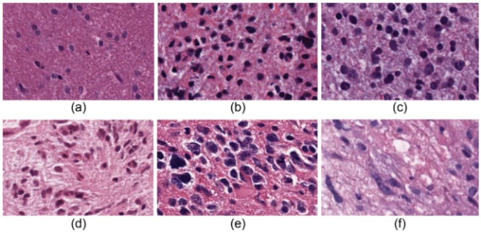 Fig. 5 Presence of irregular shaped nuclei with different proportion in (a) –(c) LG and (d)–(f) GBM images.