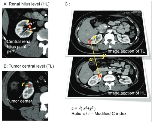 Fig. 1. The methodology of the modified C index (m-CI) measurement. (A) Image section of the renal hilum level (HL)