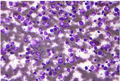 Figure 2.7. Micrograph of a diffuse large B cell lymphoma [51].