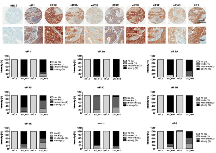 Figure 9: eIF expression in liver metastases of CC and RC compared to NNLT.   (A) Representative pictures of  immunohistochemical stainings from liver metasteses of primary CRC