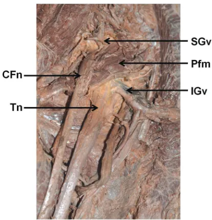 Figure 1. The left gluteal region after removing gluteus maximus; CFn — common fibular nerve; Tn — tibial nerve; SGv — superior gluteal vessels; IGv — inferior gluteal vessels; Pfm — piriformis muscle.