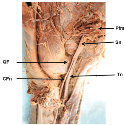 Figure 4. The right gluteal region after reflecting gluteus maximus muscle; CFn — common fibular nerve; Tn — tibial nerve; Pfm — piriformis muscle; QF — quadratus femoris muscle; Sn — sciatic nerve.