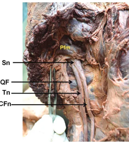 Figure 6. The right gluteal region after reflecting gluteus maximus muscle; CFn — common fibular nerve; Tn — tibial nerve; Pfm — piriformis muscle; QF — quadratus femoris muscle; Sn — sciatic nerve.