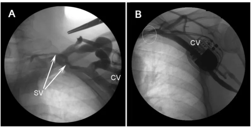 Figure 2. Anatomical cephalic vein (CV) variations involving a supraclavicular jugulocephalic vein (JCV) with a diameter larger than that of the ‘main’ vessel (selective venography images); A