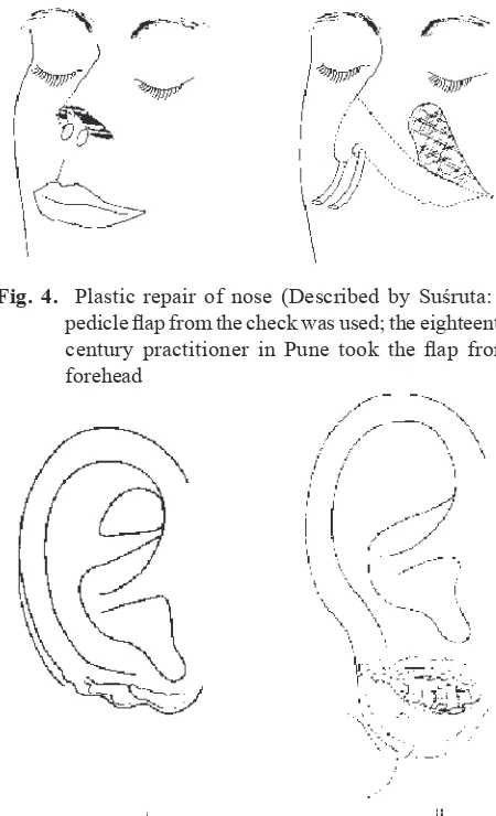 Fig. 4.  Plastic repair of nose (Described by Suśruta: a 