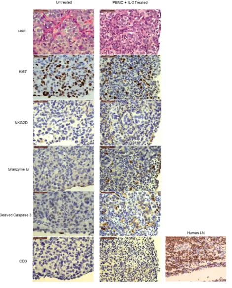 Figure 4: In vivo expanded NK cells infiltrate tumors and mediate tumor killing.  The left panel shows representative images  of a tumor nodule from the ‘untreated’ group of animals; the right panel shows that of ‘PBMC+IL-2 treated’ ones