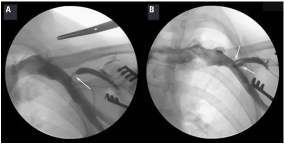 Figure 3. Cephalic vein (CV) diameter variations (white arrows); A. Narrow, poorly enhancing vessel following contrast administration; B