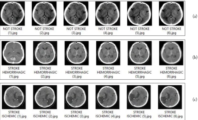 Fig. 2. Image from the data augmentation process. (a) not a stroke (b) hemorrhagic stroke (c) ischemic stroke   At this phase, three sample data are taken from each class (normal, ischemic stroke, hemorrhagic  stroke), then the data augmentation output is 