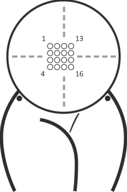 Figure 4. The recording setup. The abdominal electrodes and the tocodynamometer can be seen.