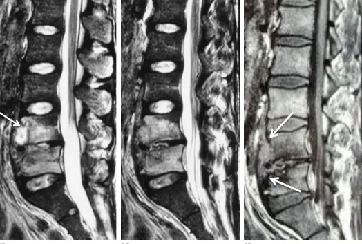 Figure 2: Patient 1. Fluid-sensitive (T2-weighted) 