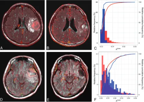 FIG 3. Representative cases. A 54-year-old man who was diagnosed with glioblastoma0.00670 minhancing T2 high-signal-intensity lesions was 0.00258minmargin (lay of thewoman was diagnosed with glioblastomasignal-intensity lesions, while the IDH wild-type in 