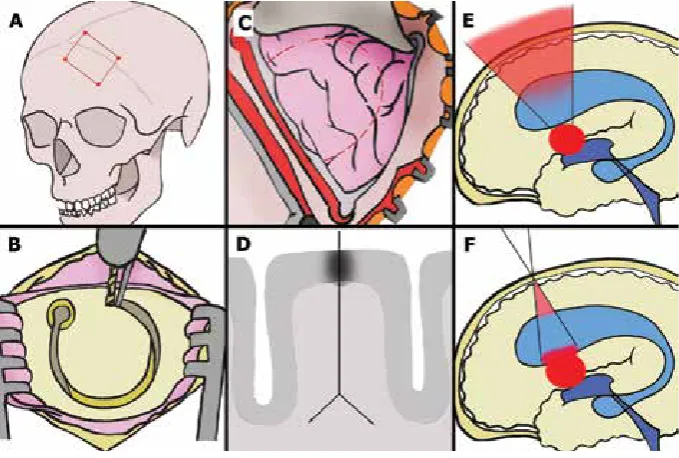 Figure 1. The placement of craniotomy, cortical incision and the idea of keyhole approach to lateral ventricle and the interventricular foramen; hydrocephalic state