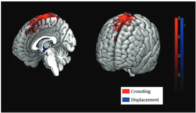 FIG 2. Spaceﬂight results in crowding of brain tissue at the vertex. Red voxels indicate regionsalong the brain surface where there was an increase in brain parenchyma pre- to postﬂight due tocrowding of the brain tissue as the brain shifted upwards