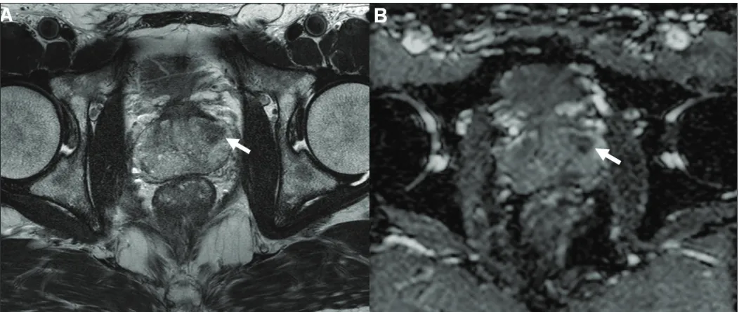 Fig. 1. A 51-year-old man with a Gleason score 3 + 3 prostate cancer and a prostate-specific antigen concentration of 2.7 ng/ml