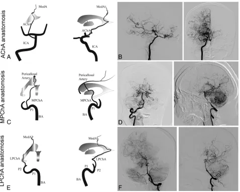 FIG 1. Schematic illustrations and angiographic ﬁndings from representative cases of each subtype of choroidal collateral anastomosis