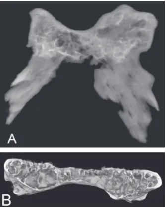 Figure 3. A radiograph of the dorsum sellae (A) and the 3-dimen-sional reconstruction of the air cells arrangement (B) showing ex-tensive pneumatisation