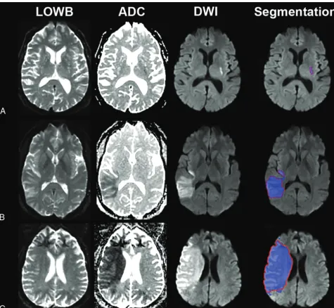 FIG 2. Sample segmentation results of the ensemble of DWI0.96 cmoutlines�ADC�LOWB (blue regions) on sample subjects along with manual outlines (red)