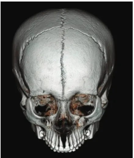 Figure 1. Persistent metopic suture is seen as vertical line at the coronal midline of cranium in 3-dimensional volume rendered com-puted tomography image of cranium in bone window.