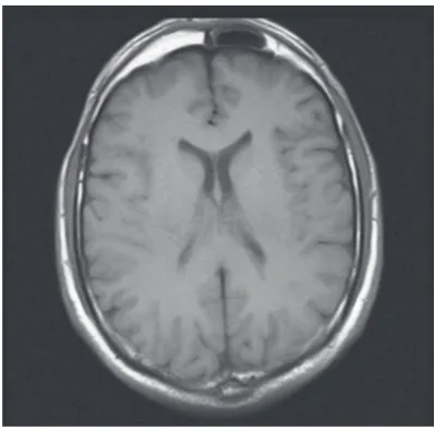 Table 2. Side distributions of the patients with metopic suture and frontal sinus atrophy together